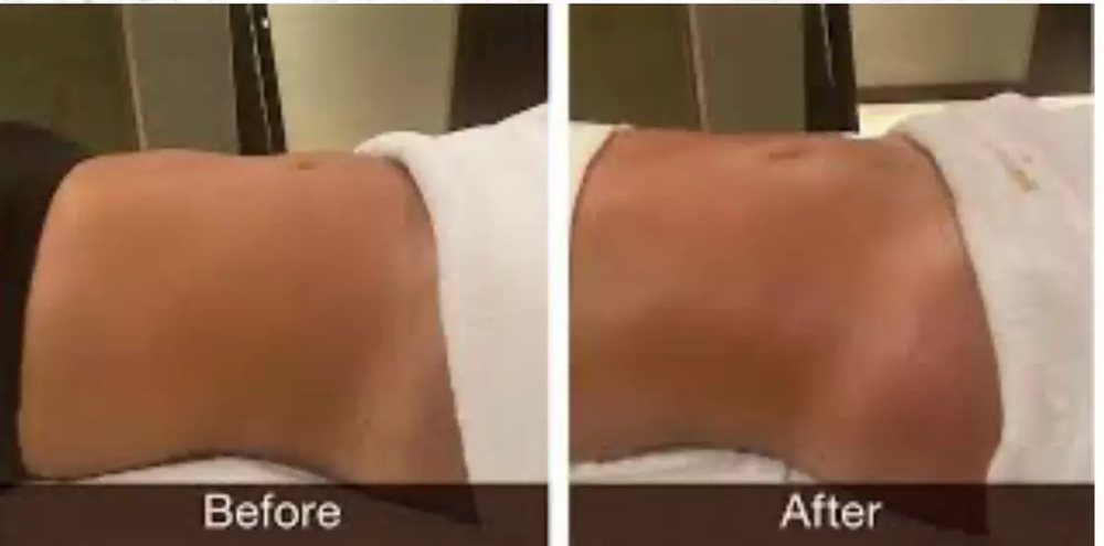 Post Op lymphatic Package Of 5