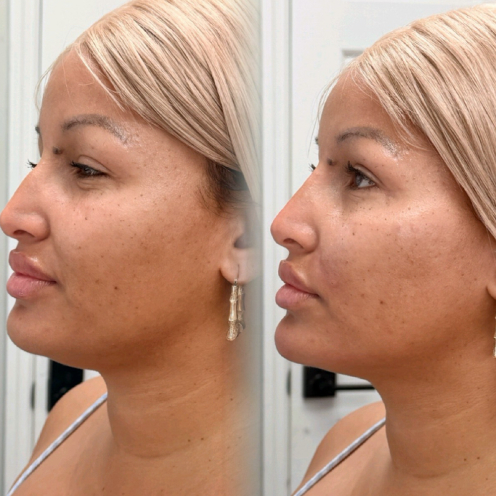 Mini Facial Balance (3) Syringe at Savage Artistry in melbourne, FL