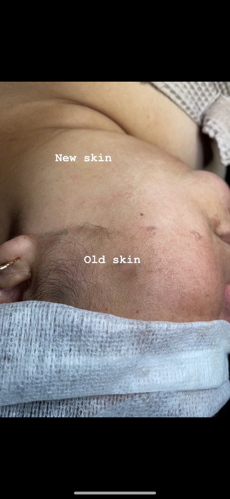 Dermaplaning Facial at Advanced Skincare & Laser By Jess in Naples, FL