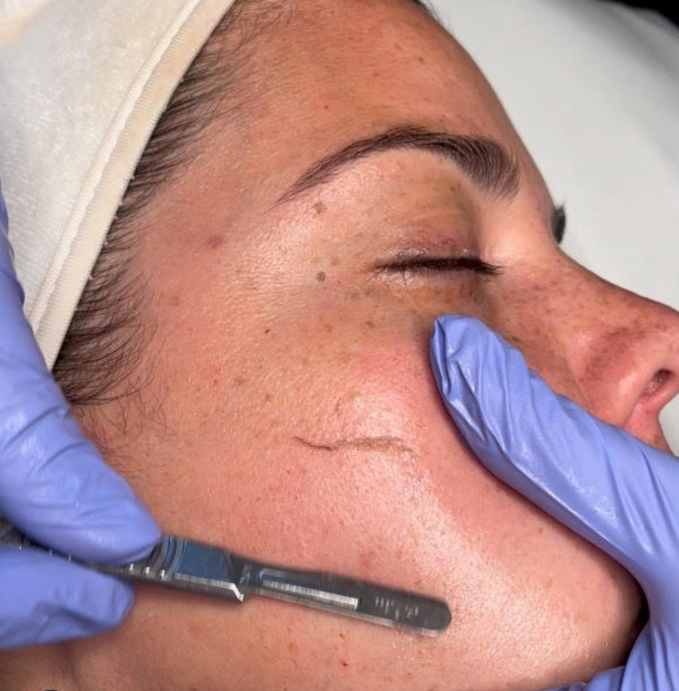 Dermaplane