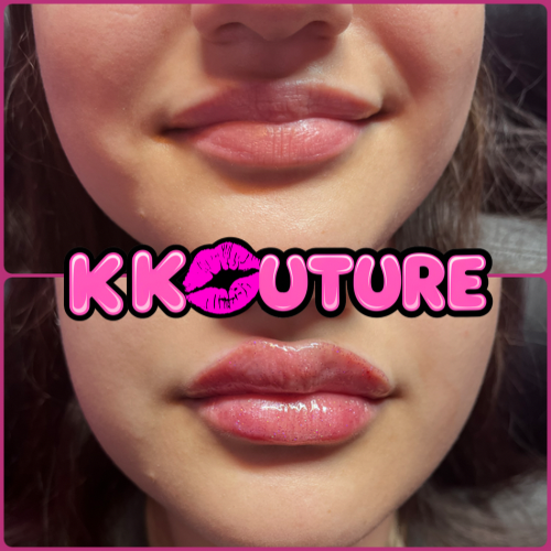 1 ML Lip Filler