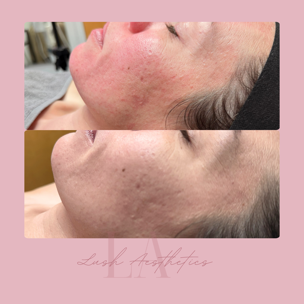 Endymed Intensif-RF Microneedling