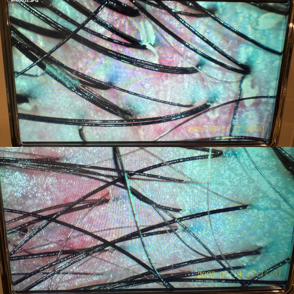 Hair Loss Consultation