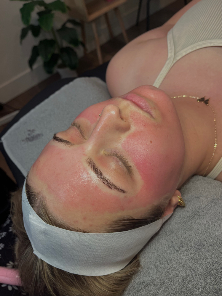 Microneedling & Chemical Peel ❤️‍🔥