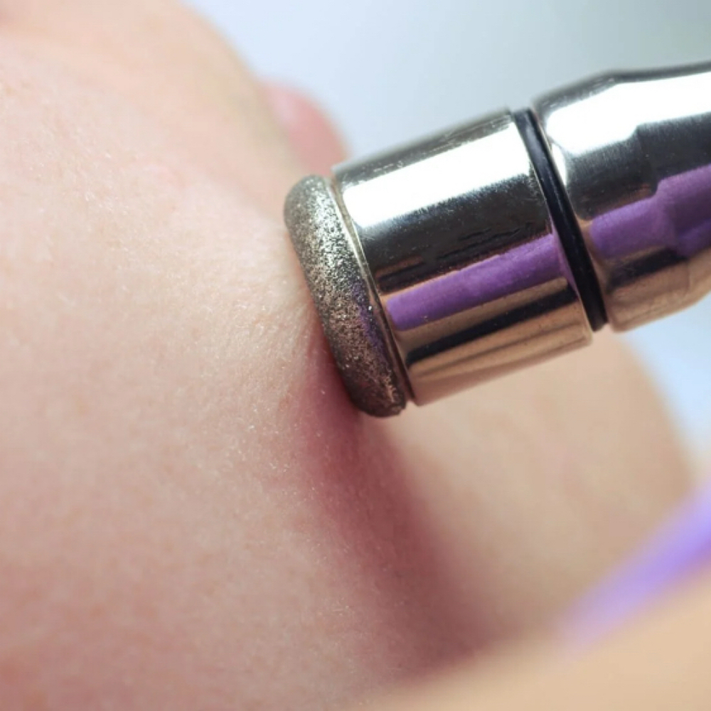 Microdermabrasion at Radiance in Modesto, CA