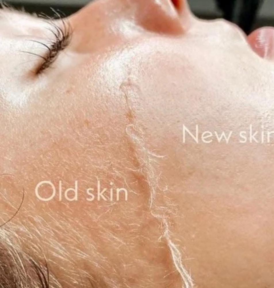 Collagen Induction Therapy