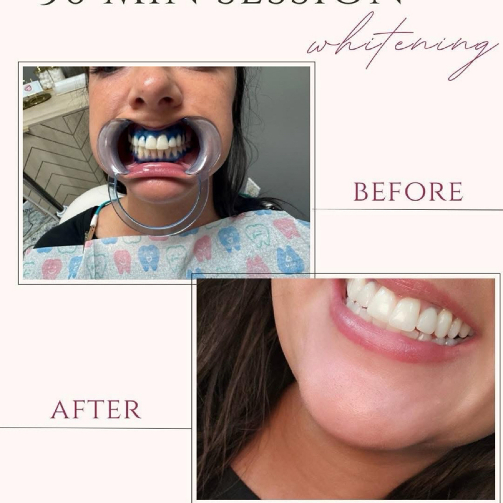 30 Min Whitening Service at ACE Smiles in Mayodan, NC