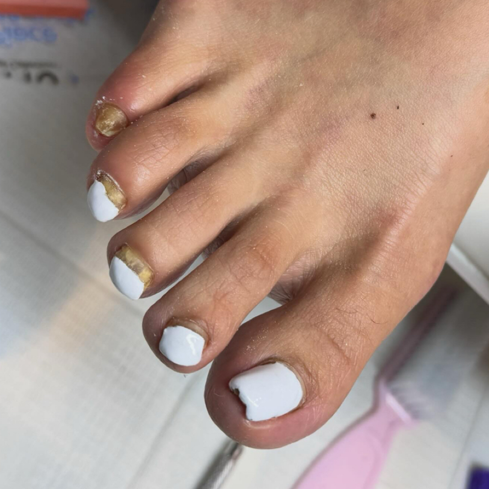 Toe Reconstruction Consultation at Nailsxxarii in Sparks, NV