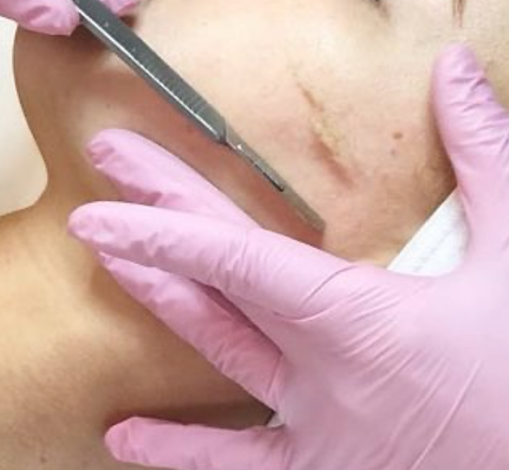 Dermaplane Add-On