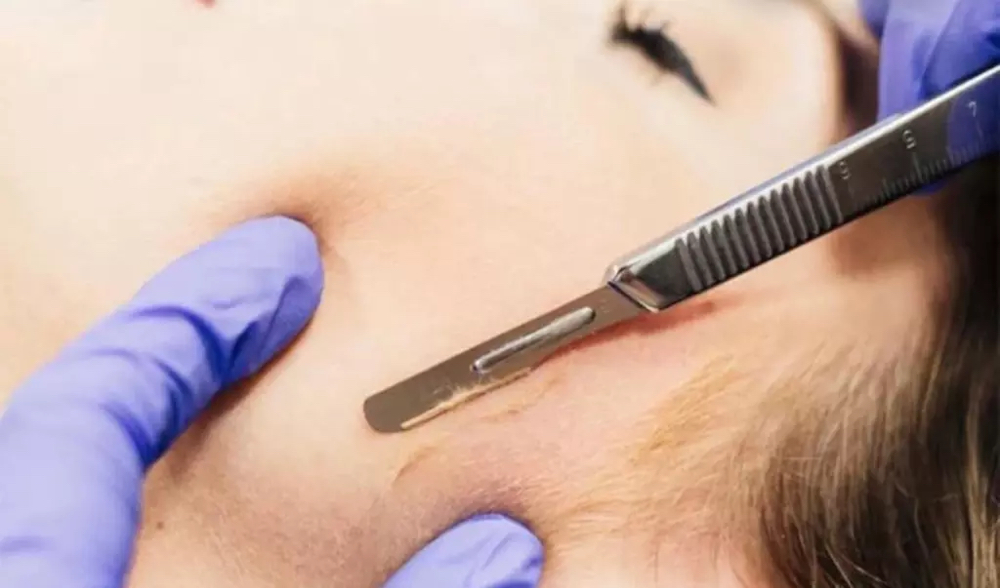 Dermaplaning