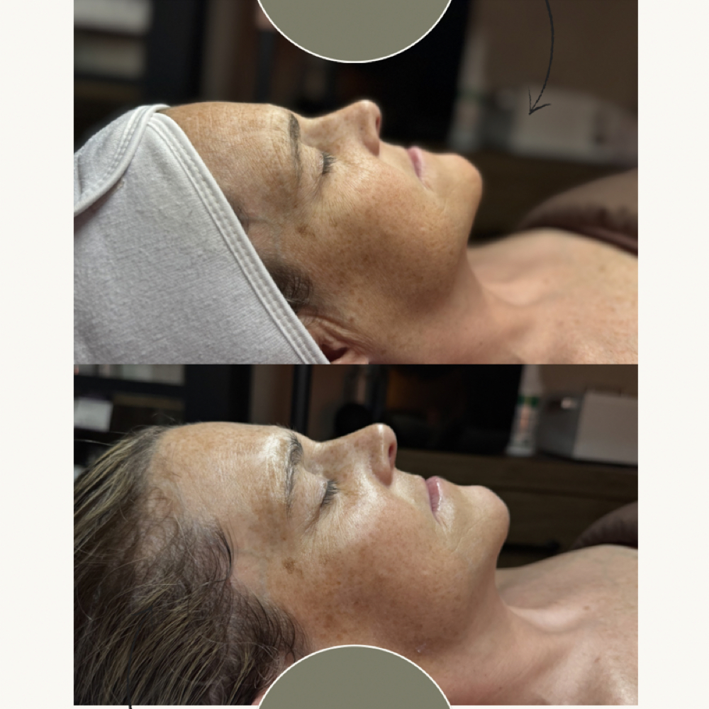 Hydrodermabrasion Facial at Satin Skin Esthetics LLC in Glens Falls, NY