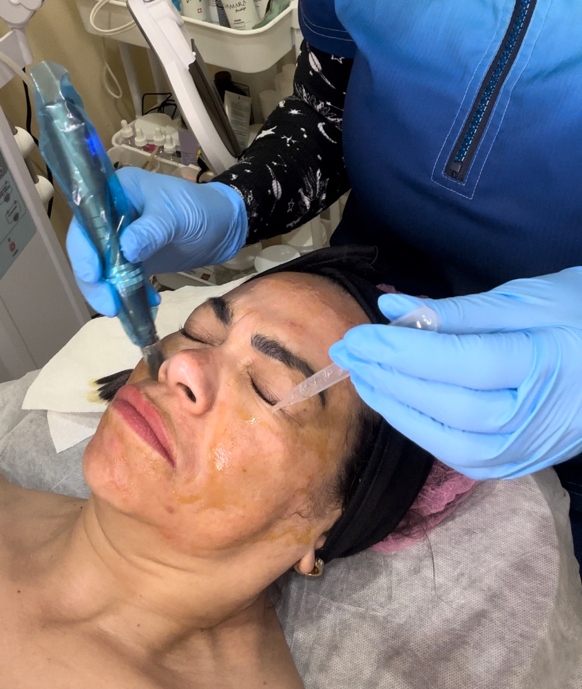 Facial Oygeneo Con Microneedling
