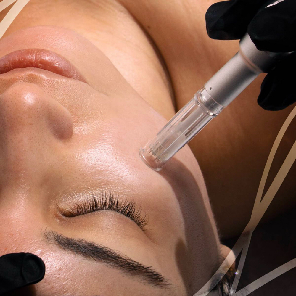Microneedling + Chemical Peel at Glo Up Bar in Saratoga springs, UT