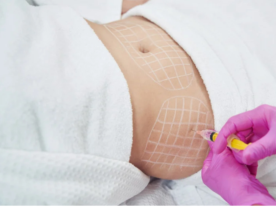 Fat Dissolving Session at Optimist Aesthetics LLC in Kingsville, TX