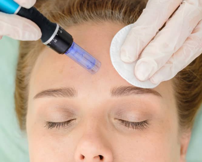 Microneedling