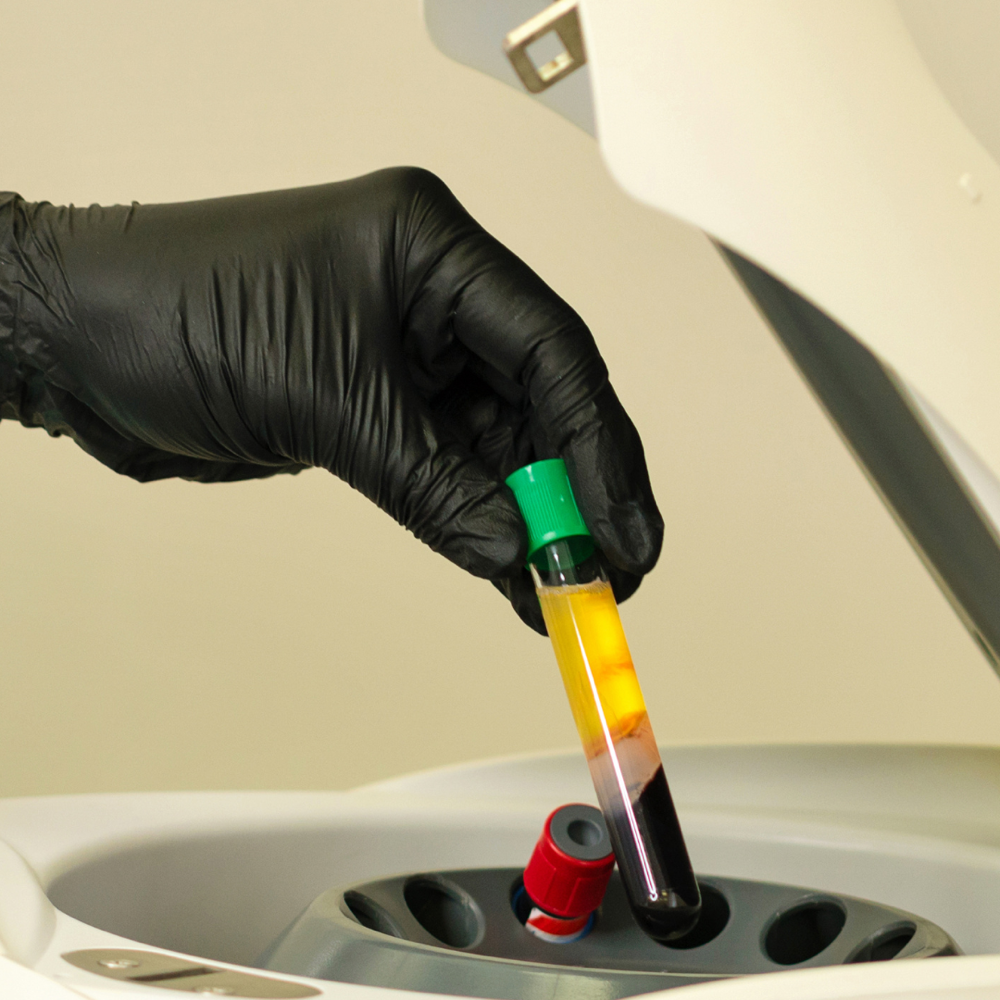 Needleless (PRP Hair Restoration)