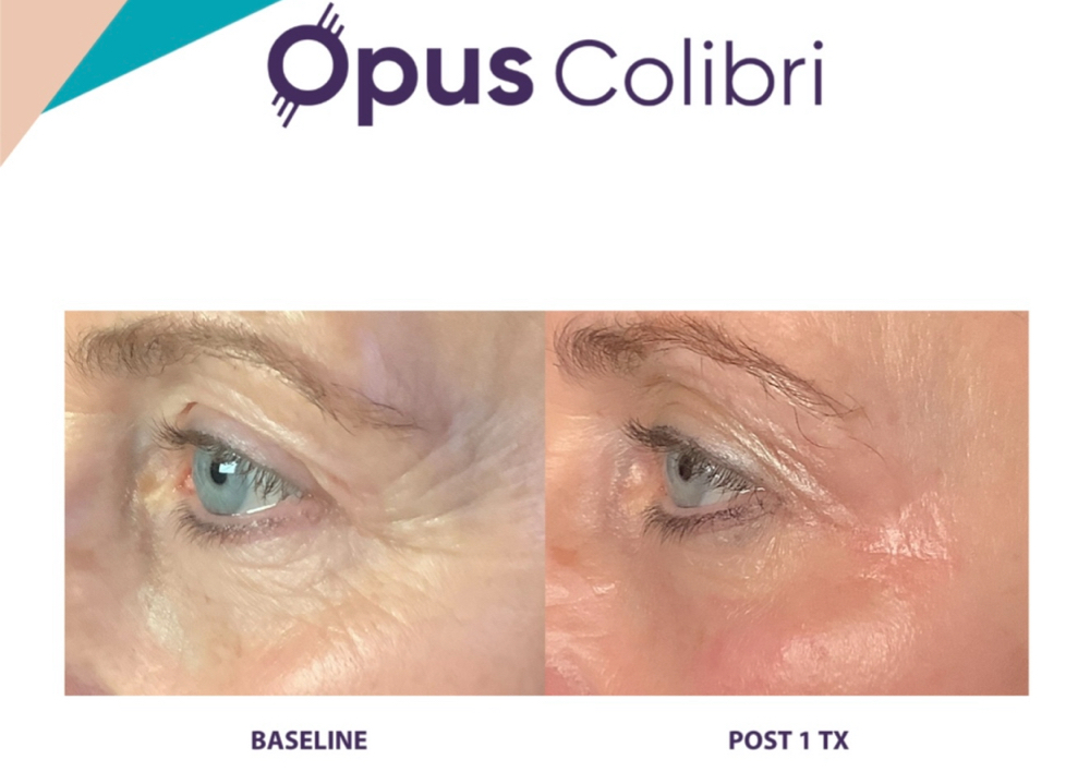 Eyes lifting Opus Colibri