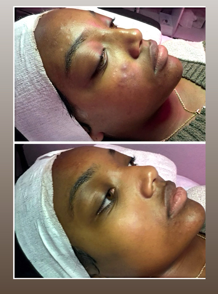 LA Rx Enzyme Glow Peel (Light Peel)