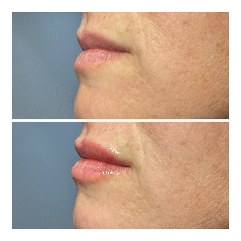 Dermal Fillers- 1/2 Syringe