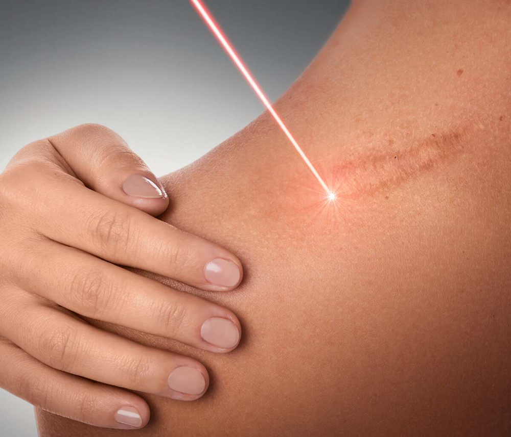 Scar Laser Removal