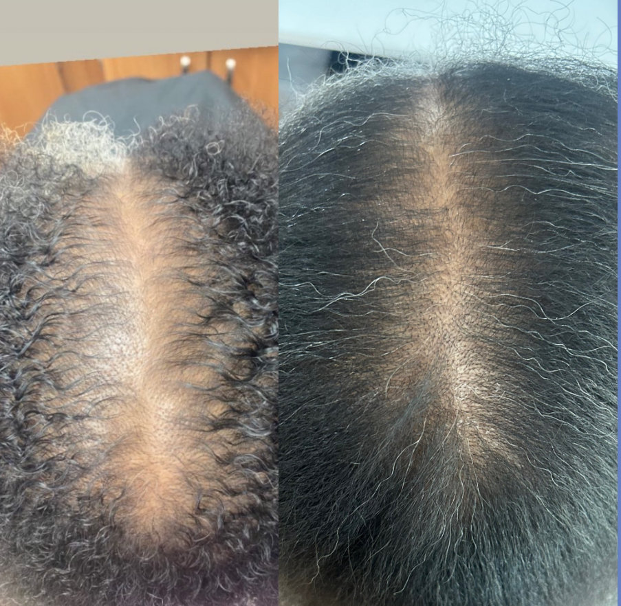 ESSENTIAL CARE -Targeted Scalp Care