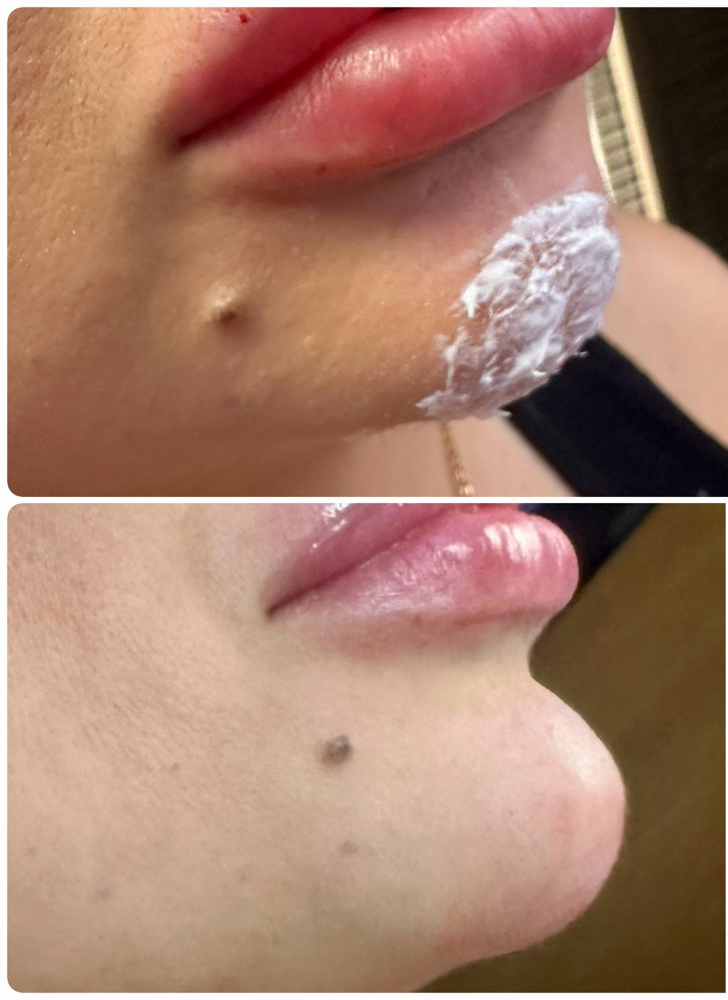 Chin Filler