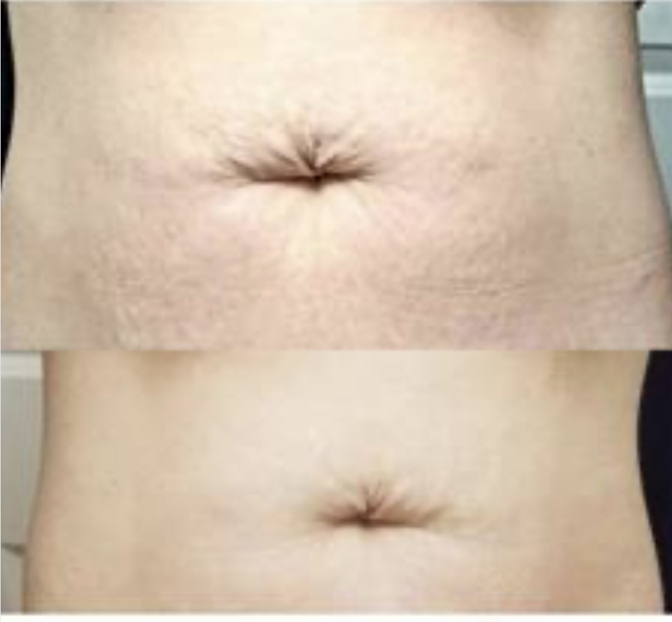 Stomach ~stretch marks Procell Micro-Channeling