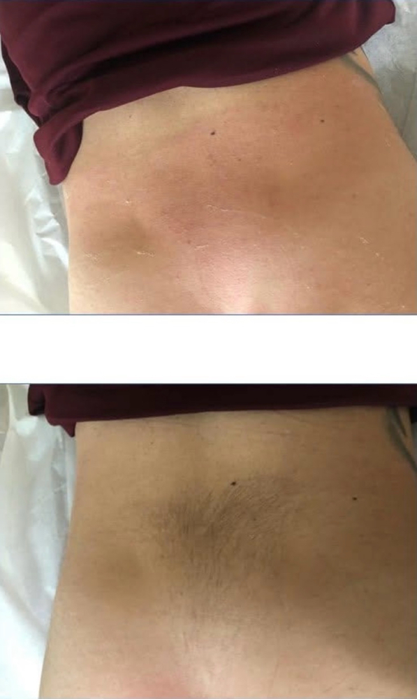 Lower Back Wax