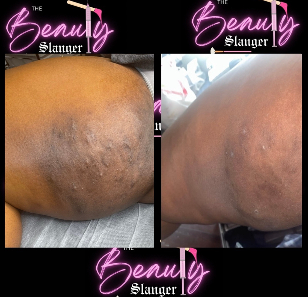 Thigh Skin Bleaching