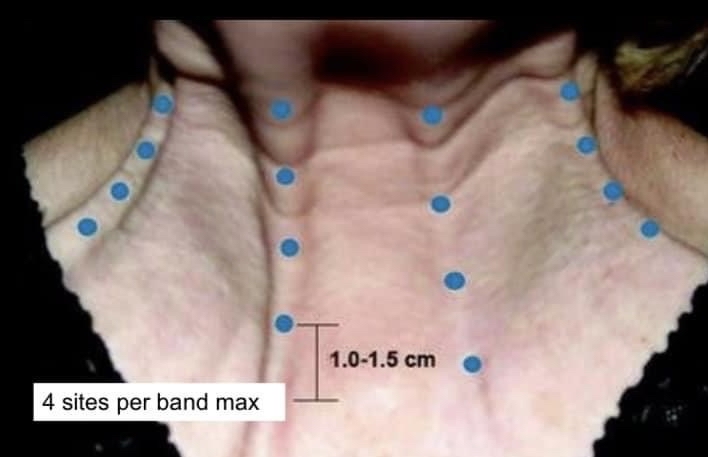 Botox-platysmal