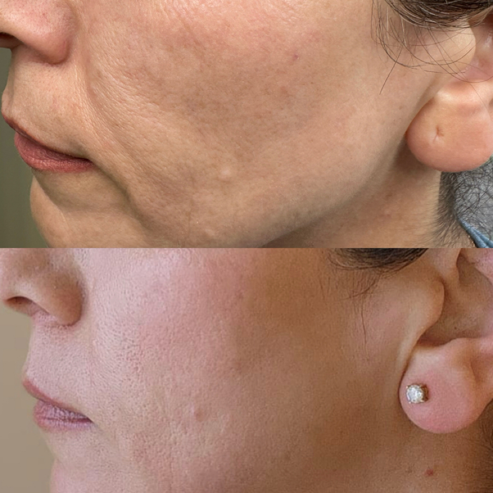Lower Face Lift at Magnolia Plasma Fibroblasting By Mitra in Frisco, TX