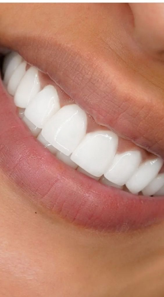 60 Minute Teeth Whitening