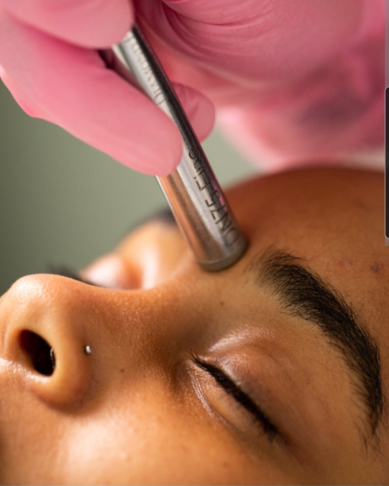 Microdermabrasion Treatment