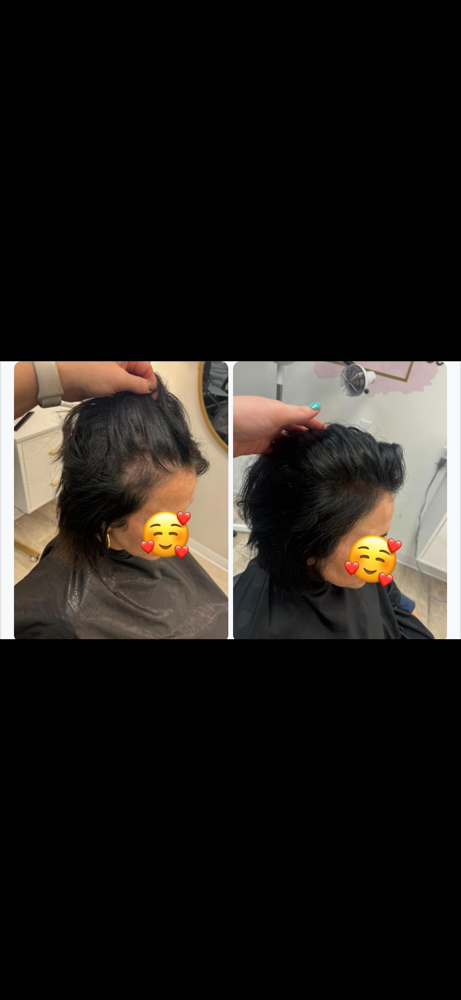 Woman Hair Growth Treatment