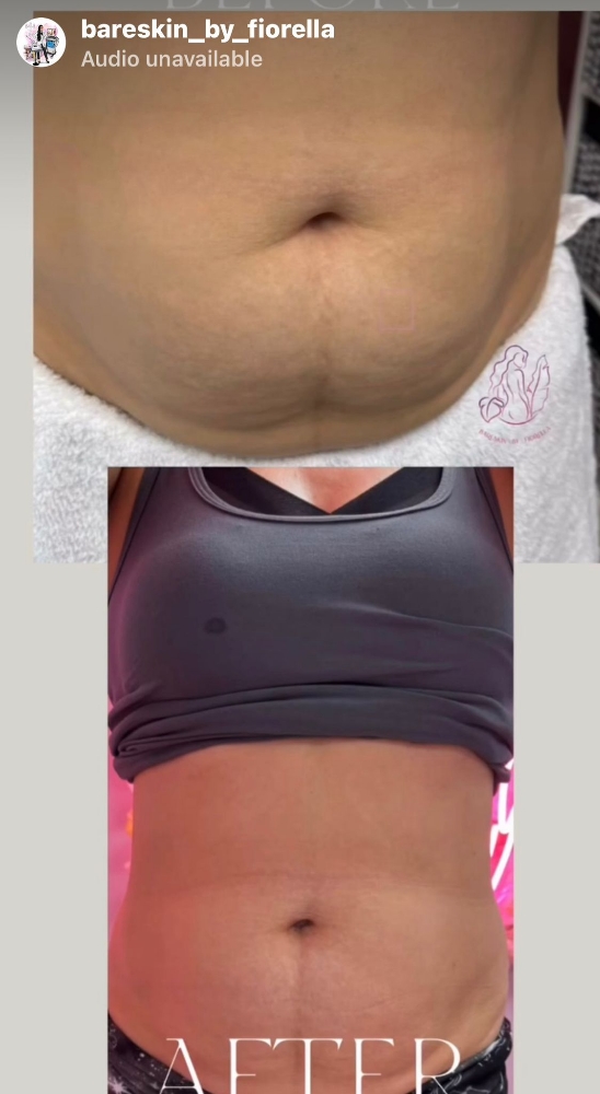 One Fat Cavitation +Lipo Laser