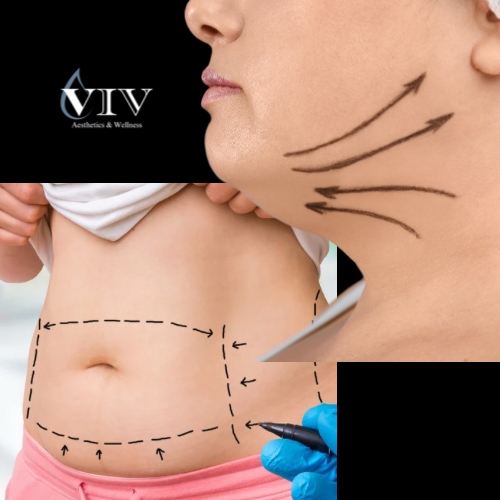 Lipo-Dissolve PCDC at Viv Aesthetics & Wellness in San Antonio, TX