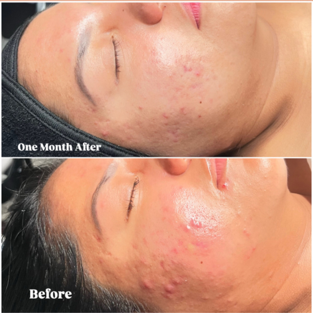 STARTER GLOW FACIAL - LEVEL 1 at D.Esthetixs Beauty + Skin in Nanuet, NY
