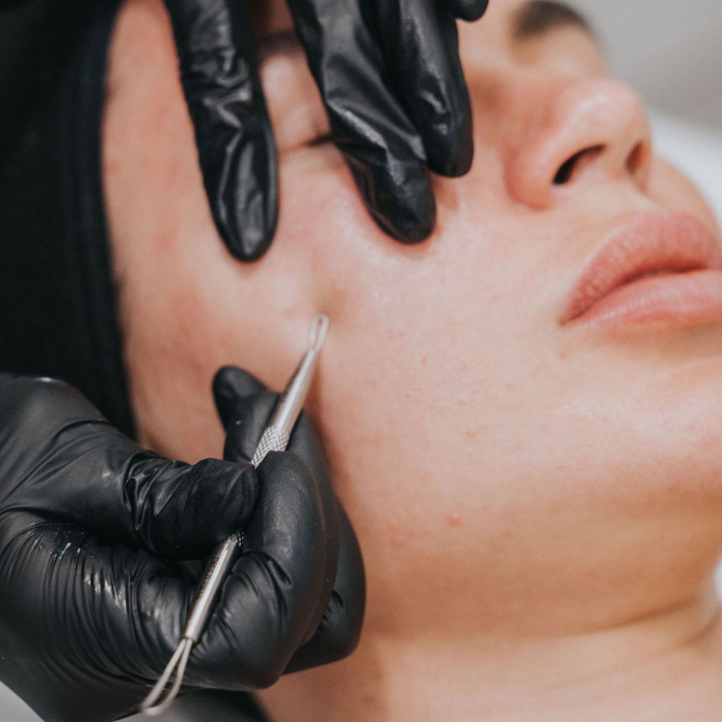 NUA Acne Skin Corrective at Nua Skin Atelier in Tampa, FL