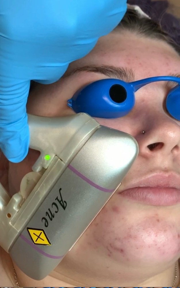 Intense Pulsed Light (IPL) Add On