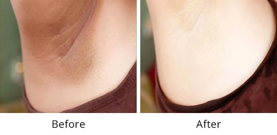 Intimate Bleaching + After Care 1st