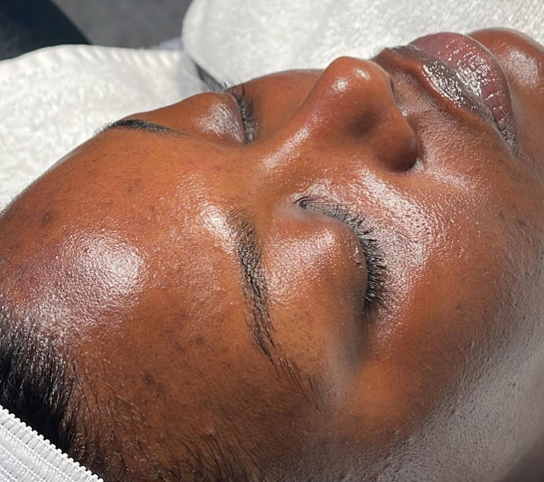 Acne Reset Bi-weekly