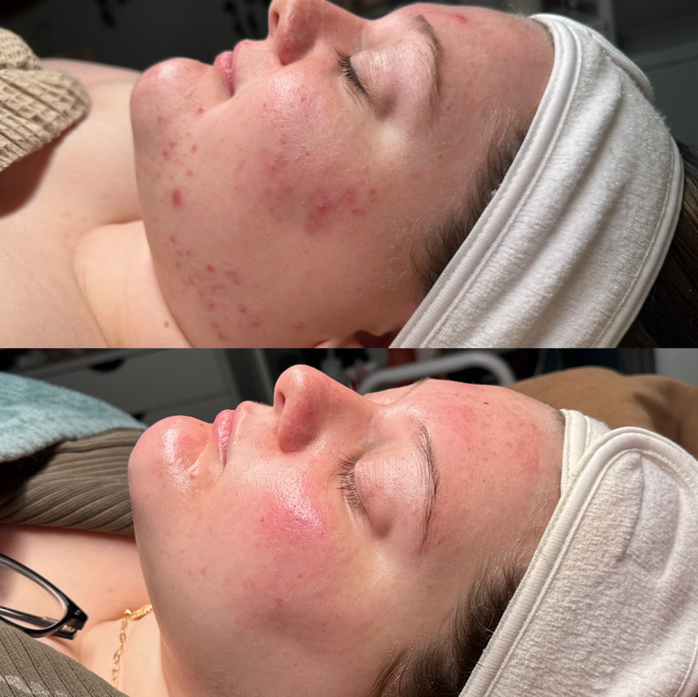 Acne Clearing Treatment