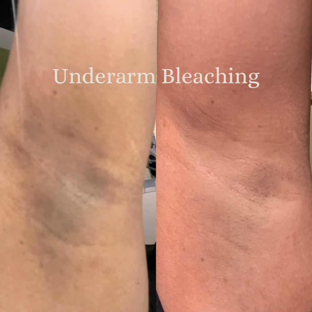 Underarm Bleaching