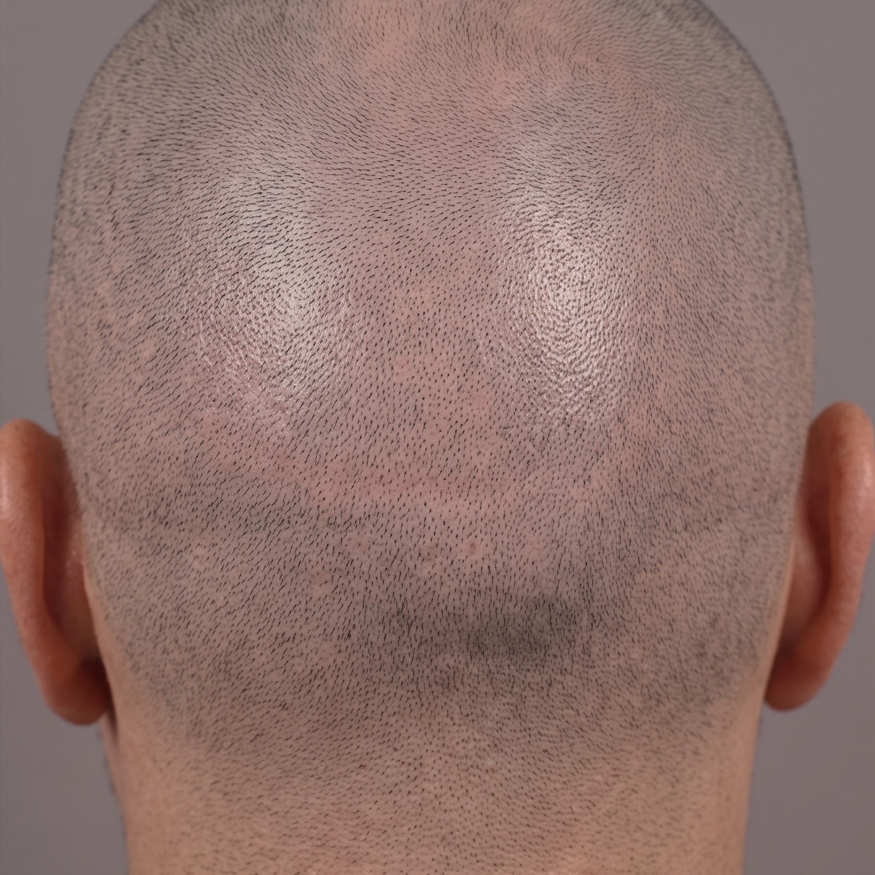 Advanced Scar Density Blending SMP at VOID SMP in Los Angeles, CA