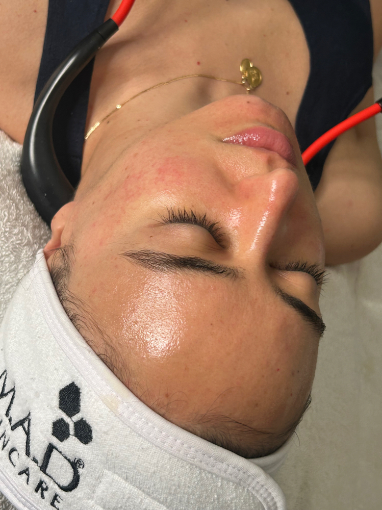 Vitamin C Chemical Peel