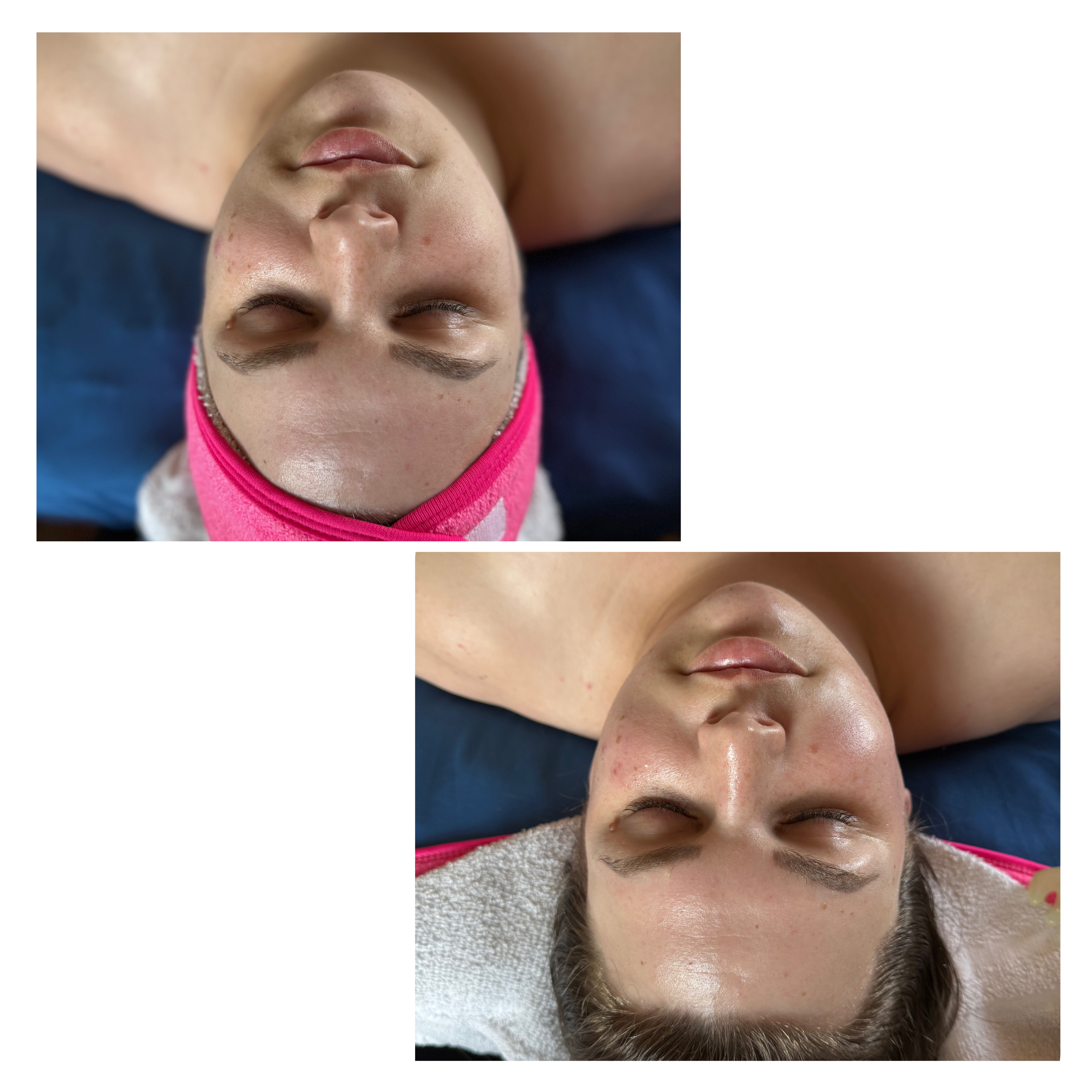 Dermaplaning Quickie