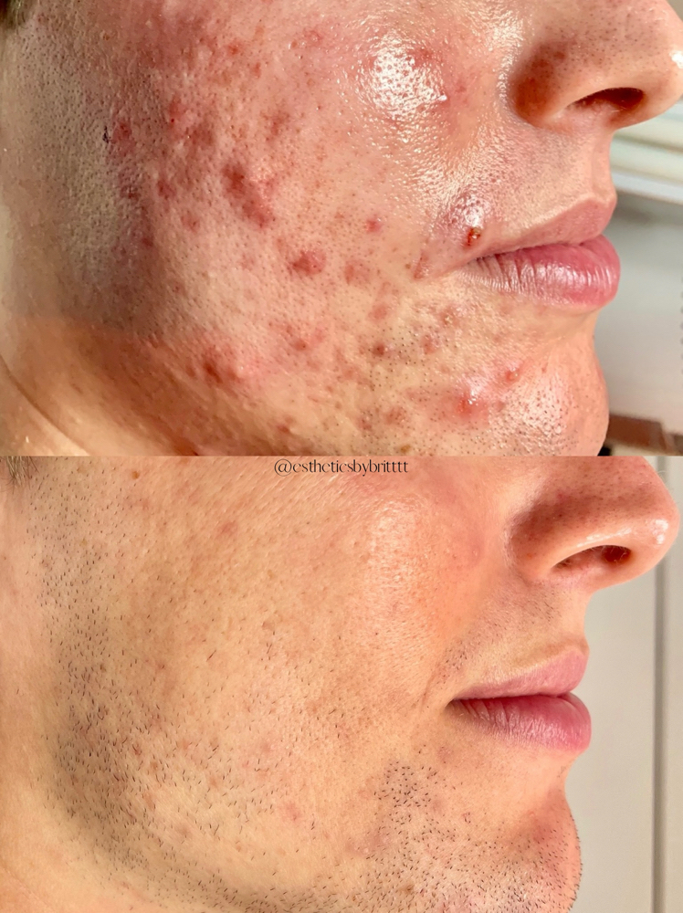 ACNE FACIAL