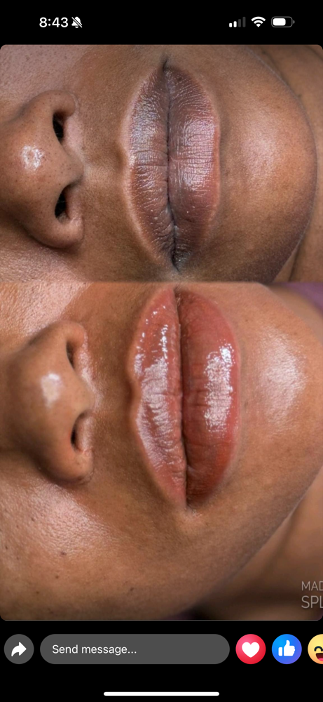 Lip neutralization