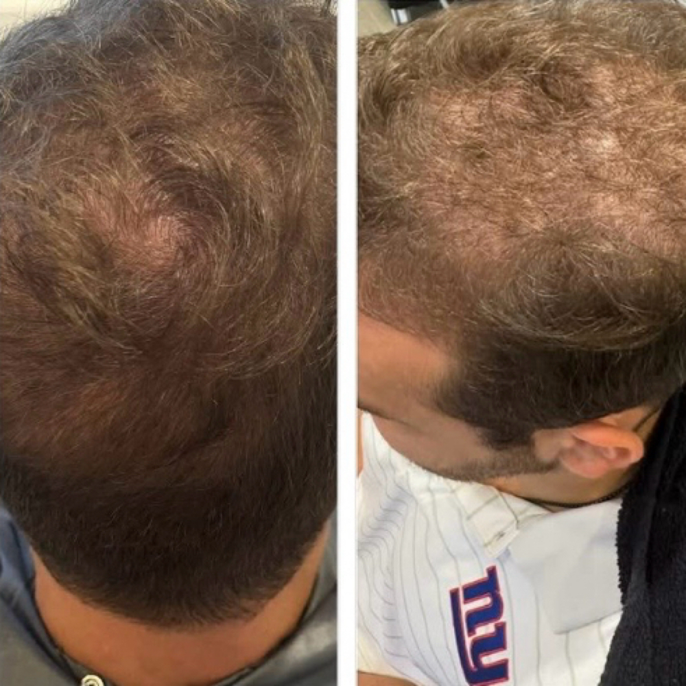 Procell Hair Regrowth System at ReNew in Fort Lauderdale, FL