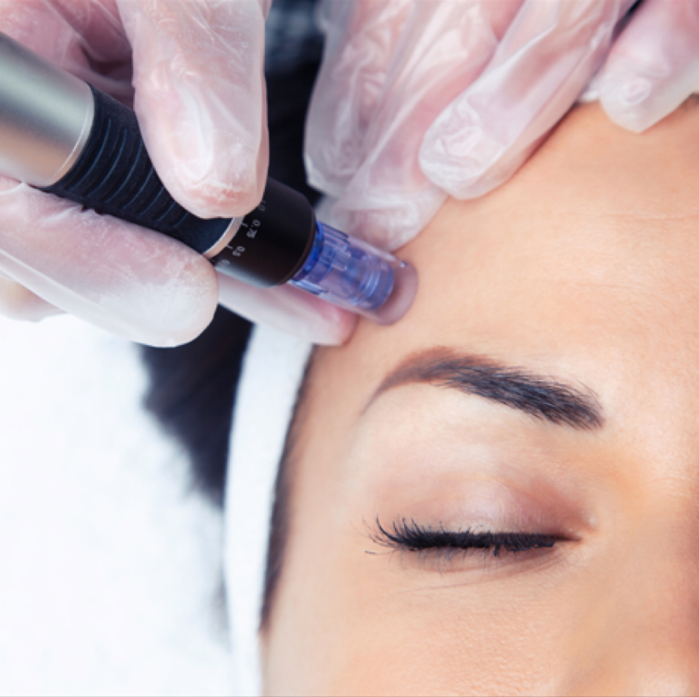 Microneedling at Esthetics by Leigh in Wareham, MA